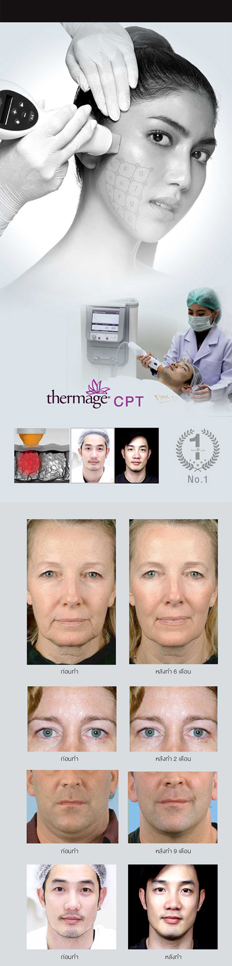 Super Lift Thermage Super Lift Thermage