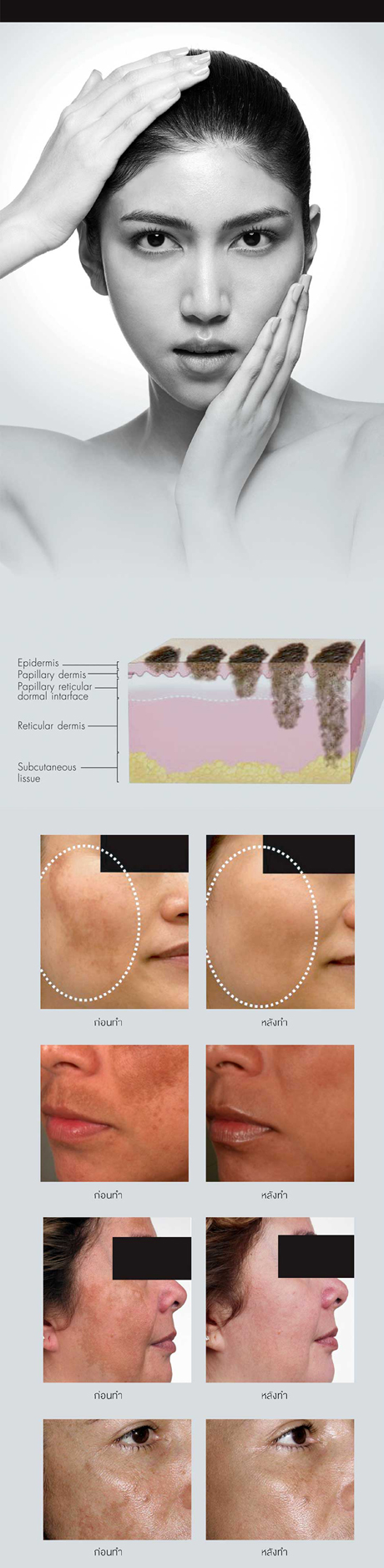 Melasma, Pigmentation