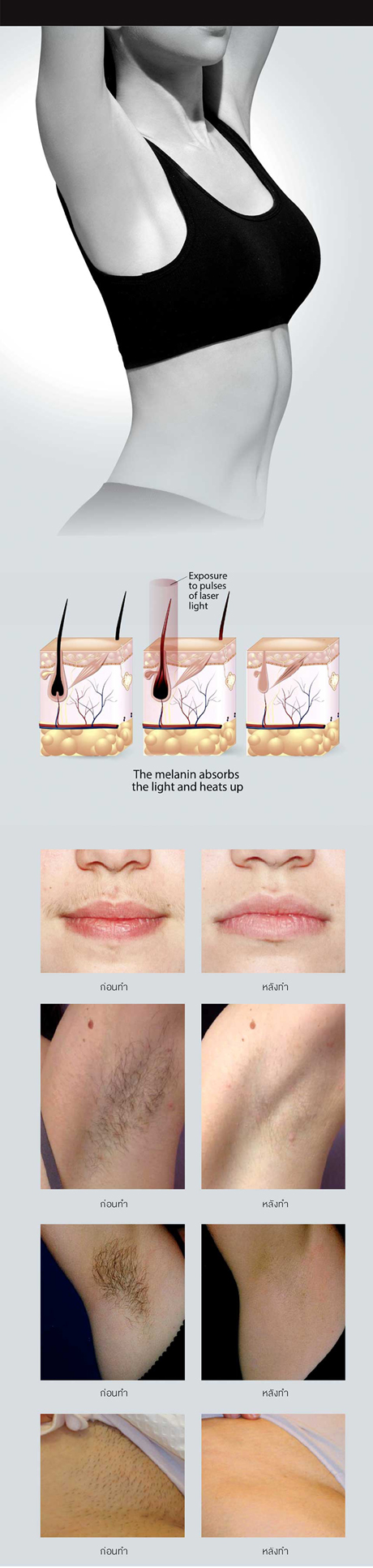 Laser Hair Removal Laser Hair Removal