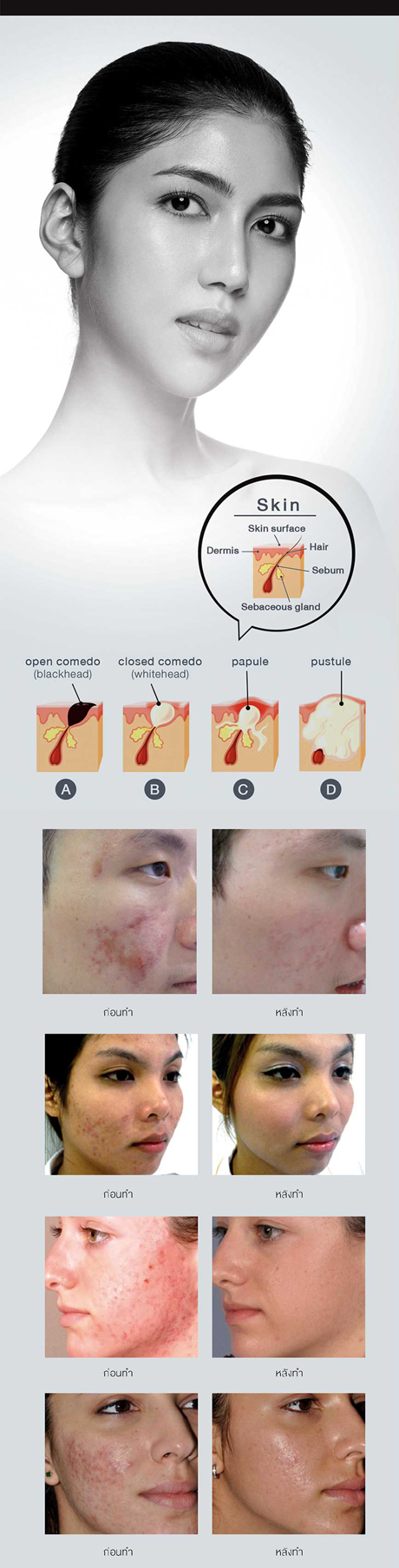 Acne Program 