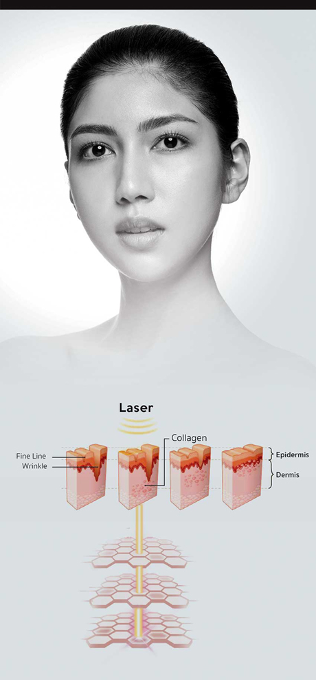 Laser Rejuvenation Laser Rejuvenation