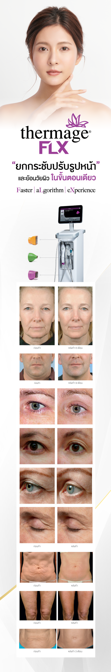 Thermage FLX Thermage FLX